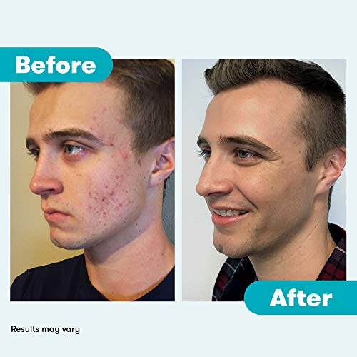 Gentle Acne Wash for Face and Body 8oz, Clear Skin Formula - Image 6
