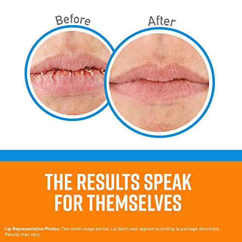 Gentle Acne-Safe Lip Balm for Fungal Skin Relief, 0.15 oz - Image 4