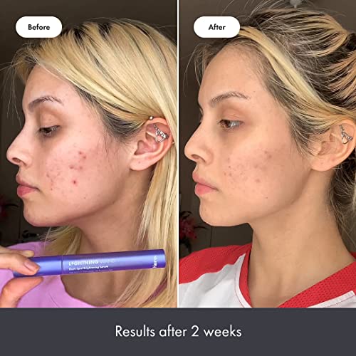 Clinique Acne Treatments & Kits: Clear Skin Solutions - Image 6