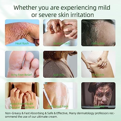 Natural Antifungal Foot Cream for Itch Relief and Healthy Feet - Image 5