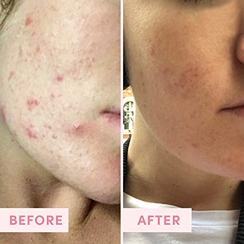 Clinique Blackhead Solution: Clear pores and prevent breakouts. - Image 6