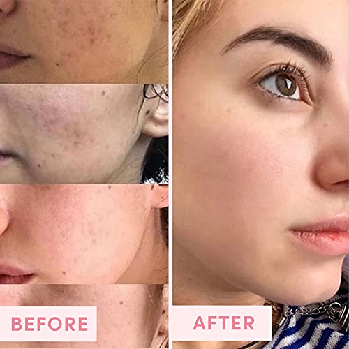 Clinique Blackhead Solution: Clear pores and prevent breakouts. - Image 5
