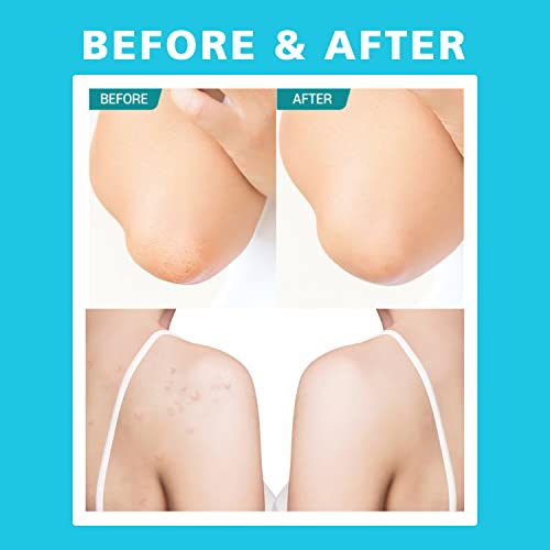 Shower Gel for Back Acne - Image 5