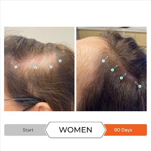 Bioderma Anti Dandruff Shampoo ? Controls Flakes and Itching - Image 4