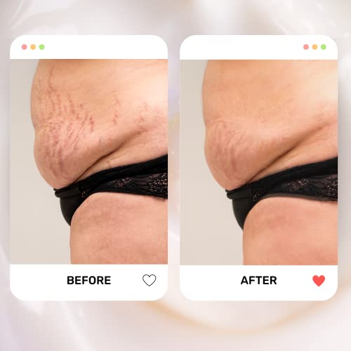 It Works Stretch Mark Moisturizer Body Cream for Visible Improvement - Image 8