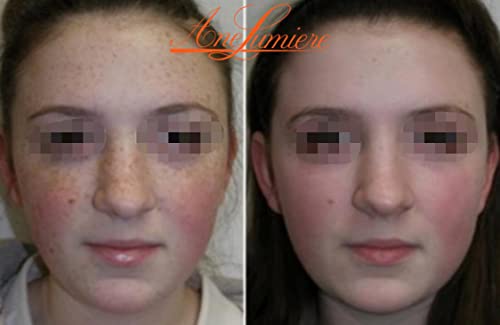 Jessner Peel: Exfoliating Treatment for Skin Renewal - Image 2