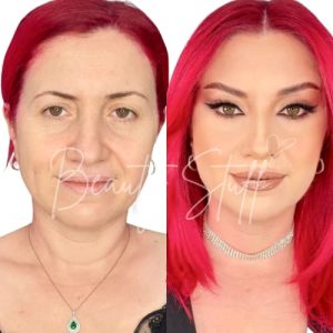 Non Surgical Anti Ageing Treatments