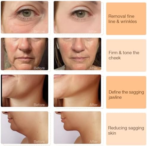 ?RF Device: Tighten Skin, Boost Collagen, Reduce Wrinkles? - Image 3