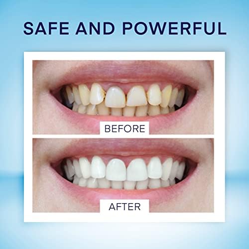 Teeth Whitening Pen Set (4 Pens), 40+ Uses, Painless, Travel-Friendly, Mint Flavor - Image 2