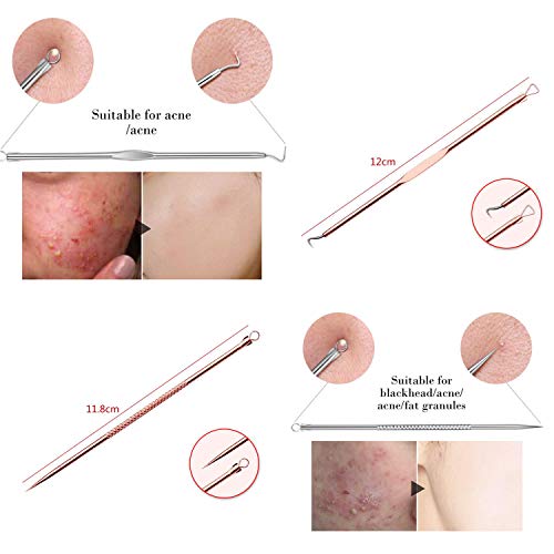 4-Piece Rose Comedone Extractor Kit for Safe Acne Removal with Case - Image 5