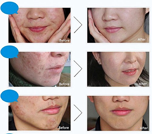 BIOAQUA 30g Anti-Wrinkle Acne Cream for Spots, Scars, and Blemishes - Image 7
