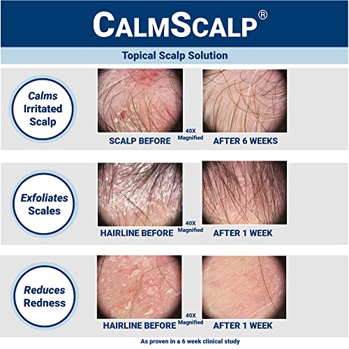 Topical Solution for Mild to Moderate Psoriasis on Scalp - 4 oz, USA Made - Image 2