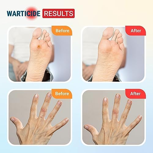 Fast-Acting Wart Remover - Natural Plantar & Genital Wart Treatment (1 fl oz) - Image 2