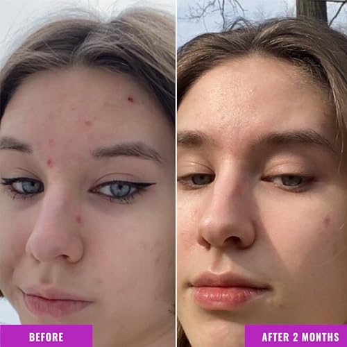 Good Molecules 10% Niacinamide Serum for Acne, Tone, Texture – Brightening & Hydrating - Image 4
