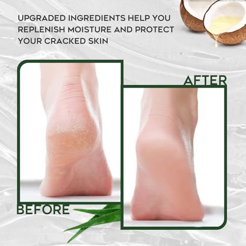 Urea 42% Foot Cream for Callus Removal and Deep Moisturizing - Image 5