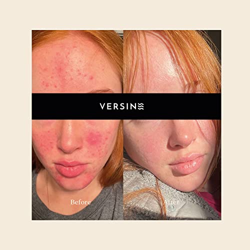 Versine Gentle Serum for Acne, Pregnancy Safe, 1Fl Oz - Image 6