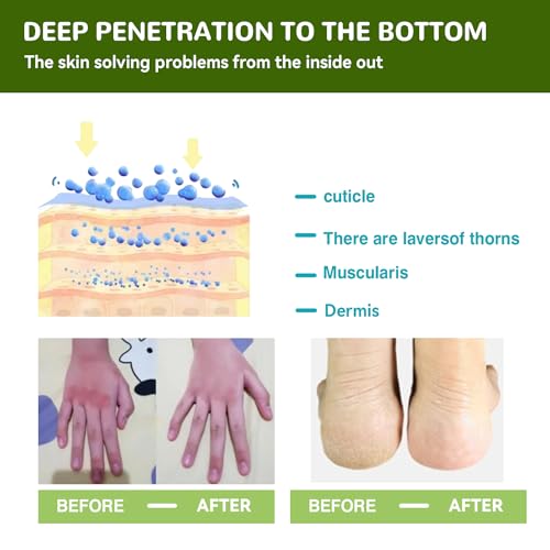 Urea 42% Salicylic Acid Hand Foot Cream for Cracks - Image 6