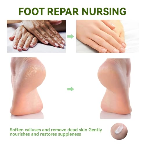 Urea 42% Salicylic Acid Hand Foot Cream for Cracks - Image 4