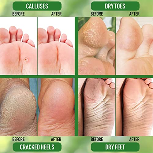 Urea 40% & Salicylic Acid Foot Cream ? Limited Edition - Image 5