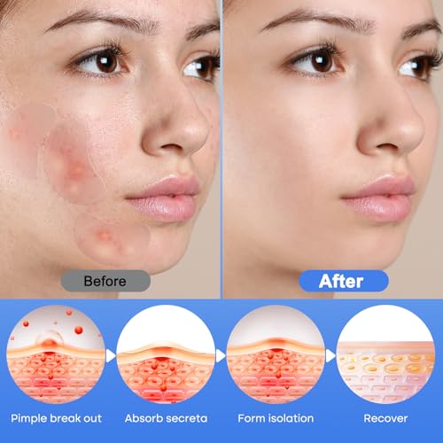 Large Hydrocolloid Pimple Patches with Tea Tree & Salicylic Acid - Image 3