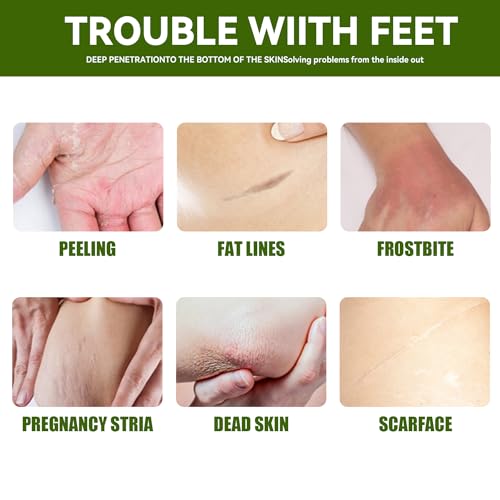 Urea 42% Salicylic Acid Hand Foot Cream for Cracks - Image 3