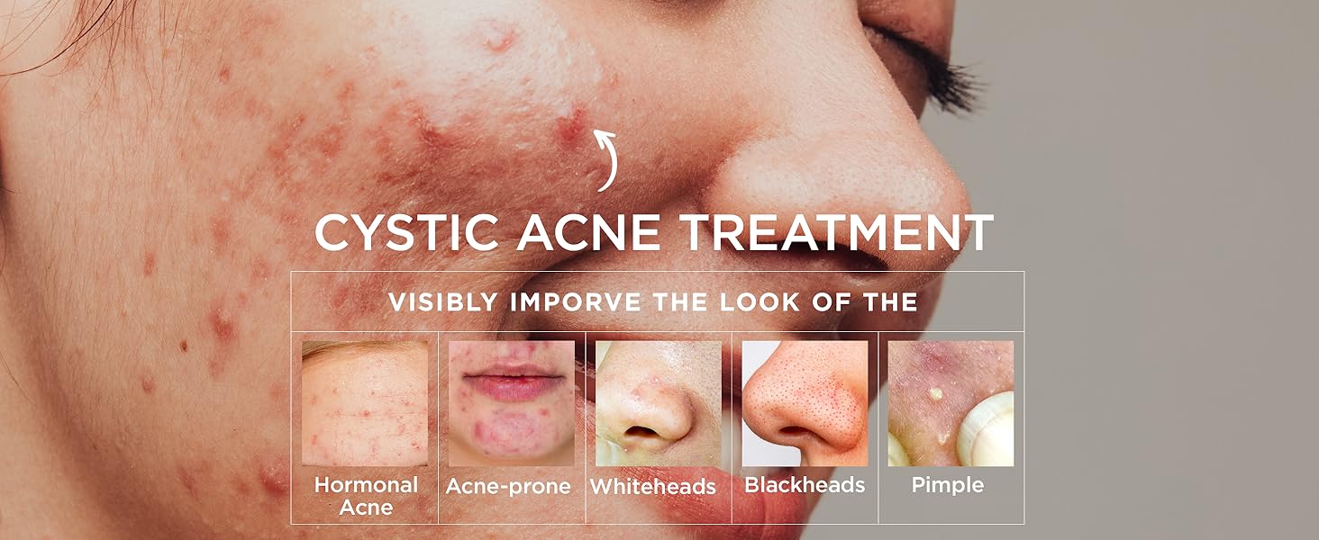 acne treatment for face
