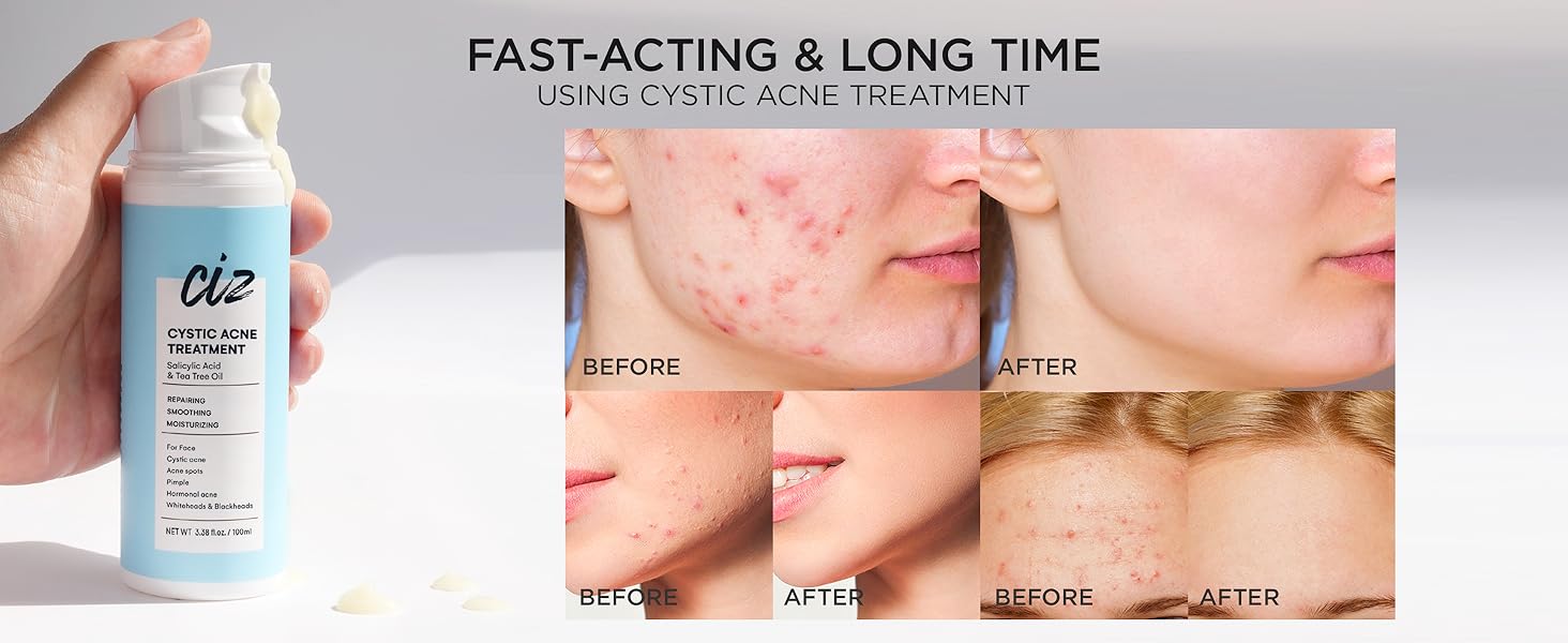 cystic acne treatment