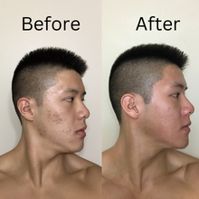 Acne Treatment Product
