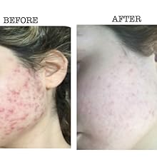 Acne Product