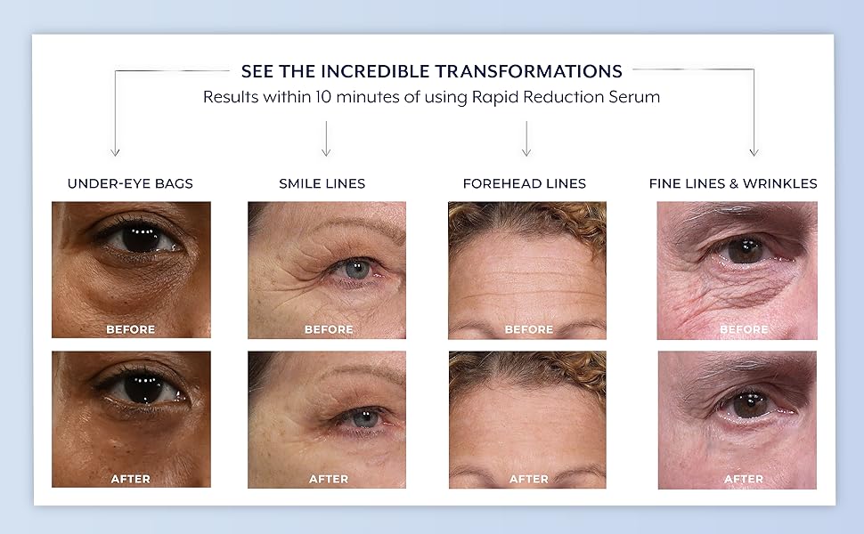 Reduce under-eye bags, smile lines, forehead lines, fine lines and wrinkles