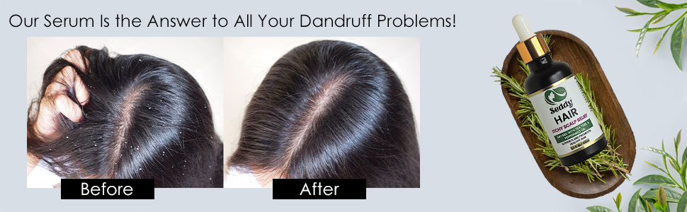Dandruff Problem Scalp Detox Tonic oil Clarifying and Purifying Itchy Dry Scalp Vegan & Cruelty-Free