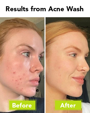 Humane Benzoyl Peroxide Acne Body Wash Detail
