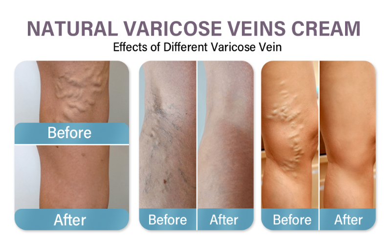 Varicose Veins Treatment for Legs