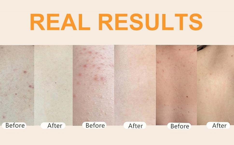 butt acne treatment cream