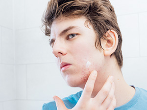 How to Use Enaskin Natruals Acne Spot Cream