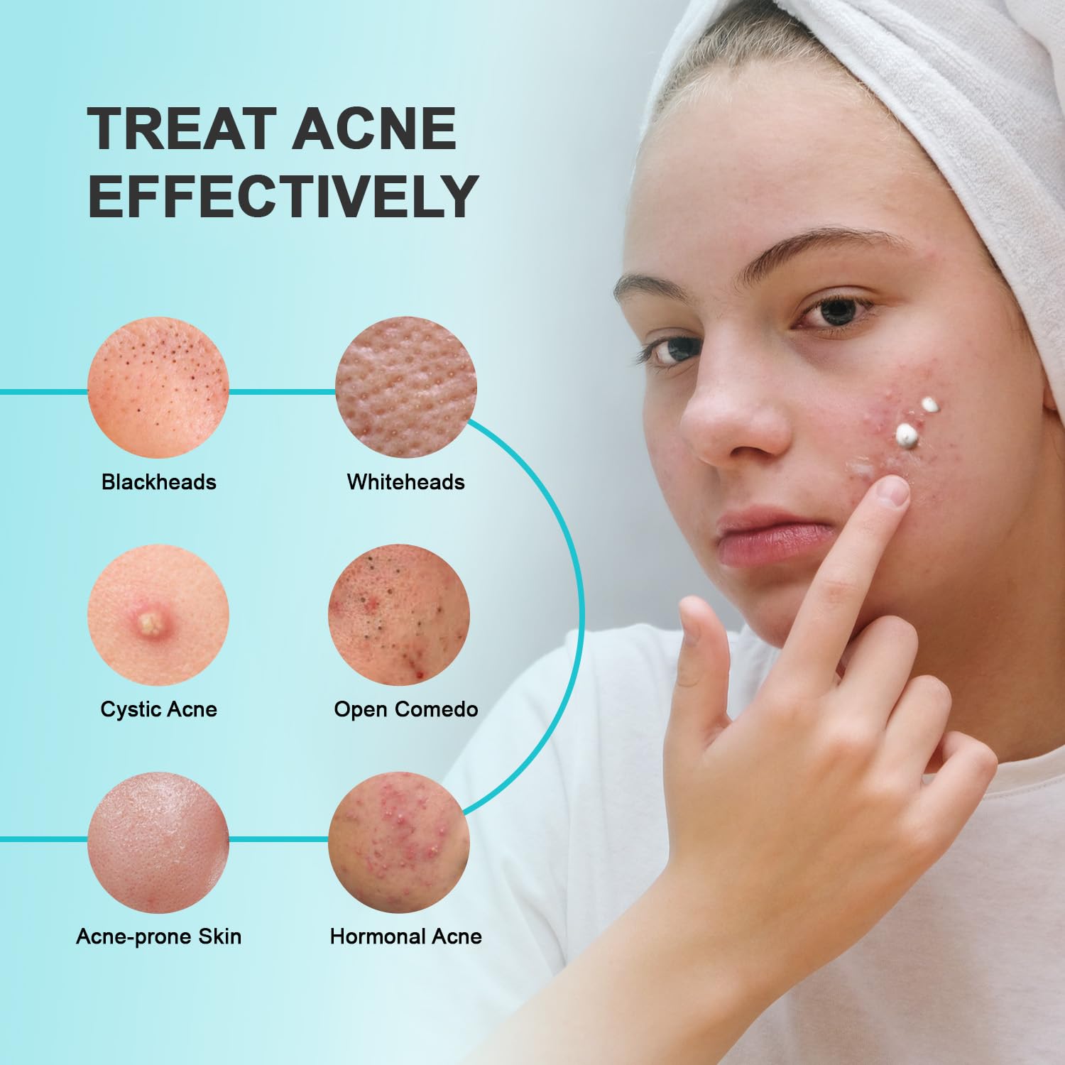 Cystic Acne Spot Treatment Cream for Face, Back and Body, Hormonal Pimple Scar Moisturizer Gel for Teens & Adults, Rapid Control and Clear Breakouts, 1.8 oz - Image 2