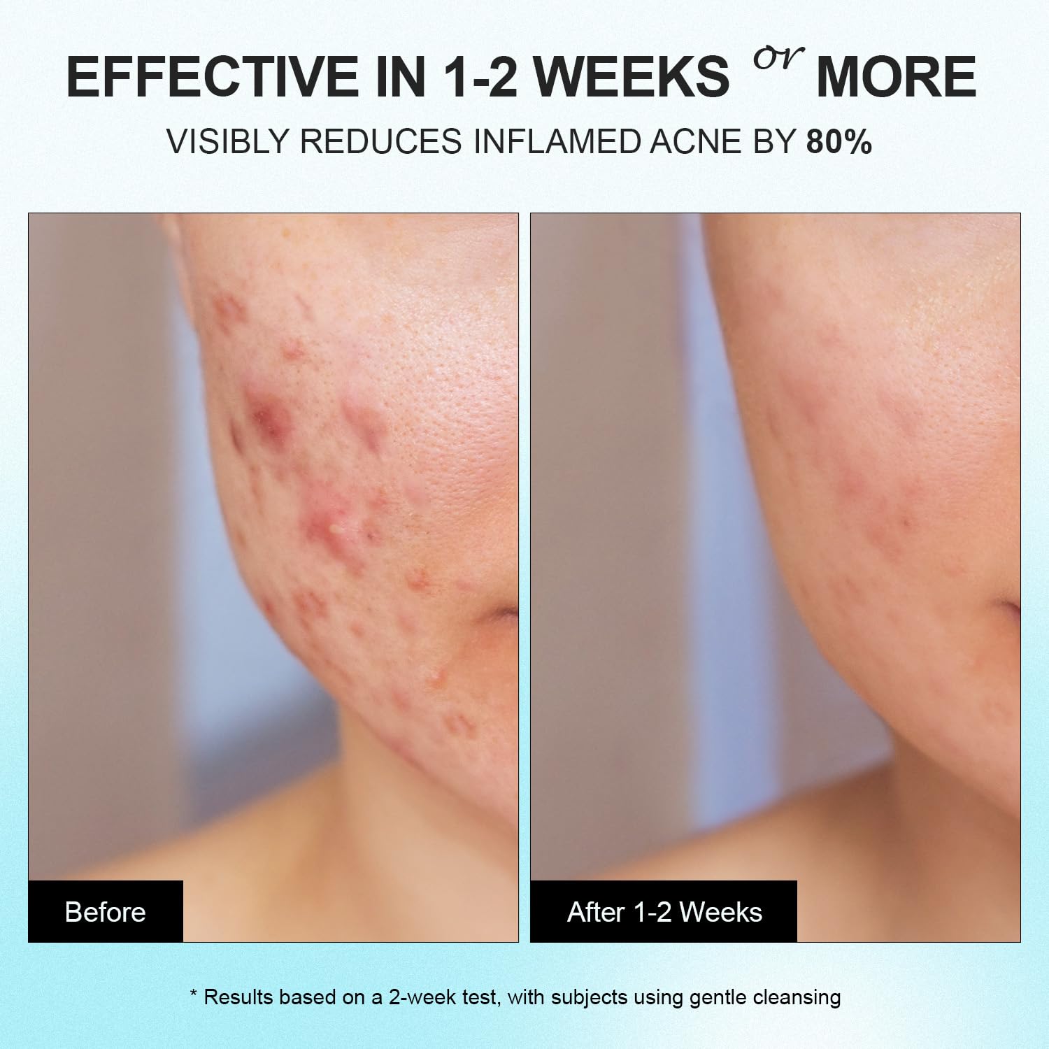 Cystic Acne Spot Treatment Cream for Face, Back and Body, Hormonal Pimple Scar Moisturizer Gel for Teens & Adults, Rapid Control and Clear Breakouts, 1.8 oz - Image 3