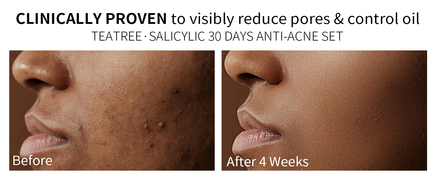 cystic salicylic acid lotion adult acne treatment for women gifts for women travel essentials