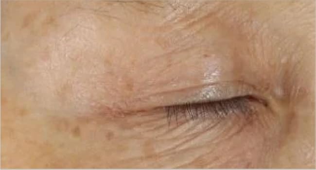 DEJ Eye Cream Before/After 2