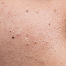 Dark spots due to aging