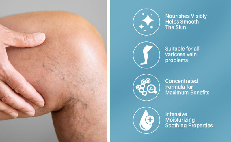Varicose Veins Treatment for Legs