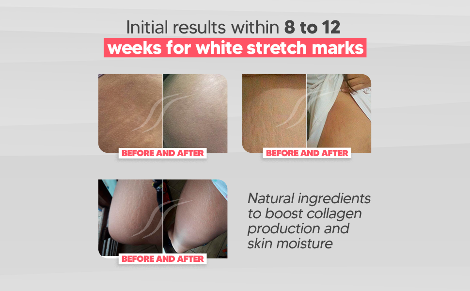 Cicatrissim White Stretch Mark Fade and Removal Cream