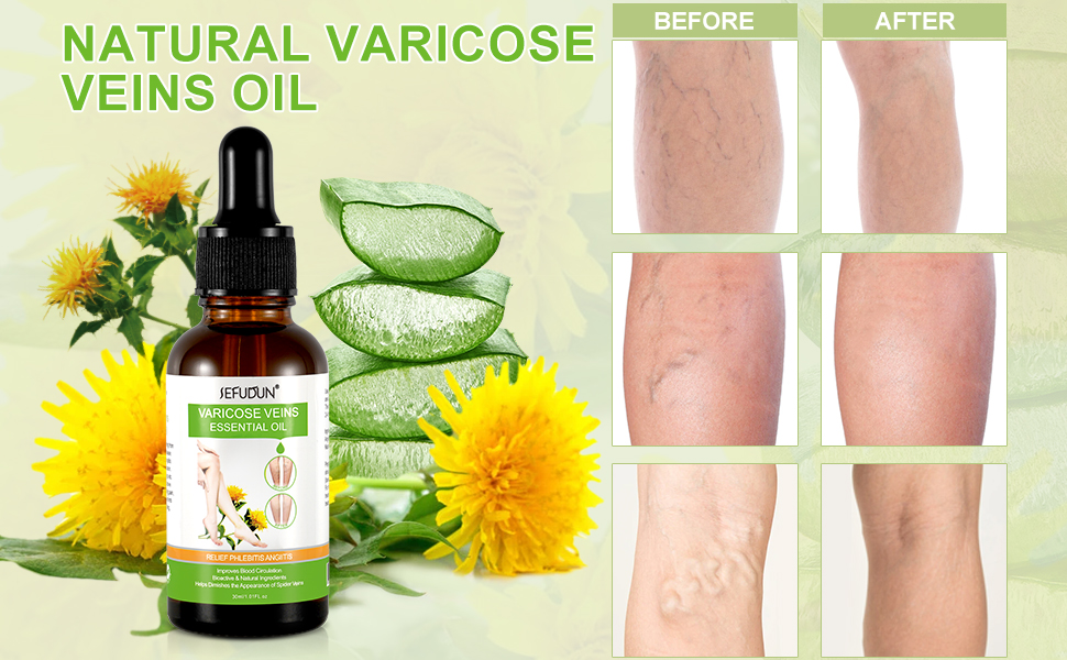 Varicose Veins Essential Oil