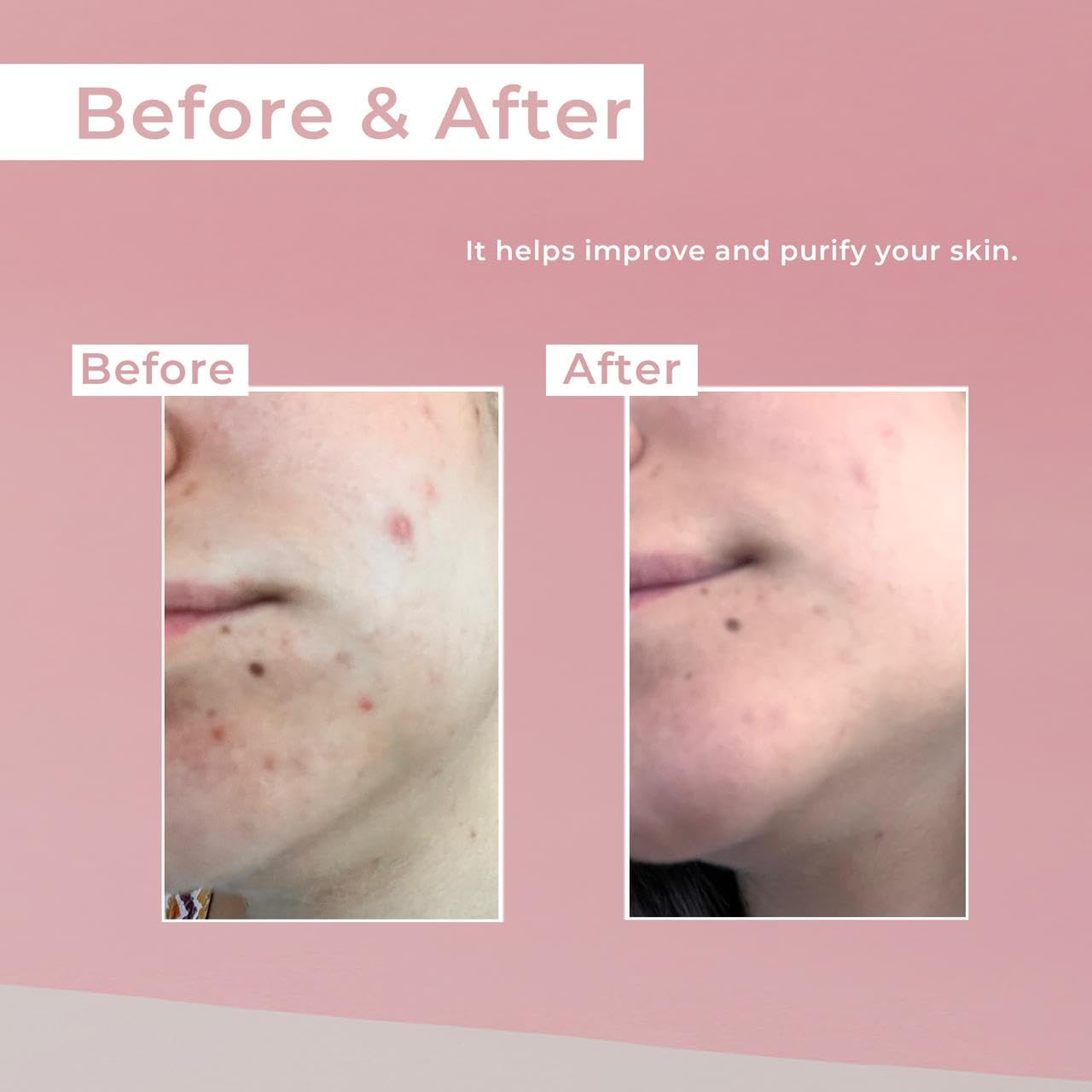 AC On-Spot Cream 30g/1.05 Oz, Zinc Oxide 10%, Niacinamide 2% for Active Skin Repair, Acne Spot Treatment for Face, Blemish Care, Dark Spot, Korean Skincare for Sensitive & Acne-Prone Skin - Image 3
