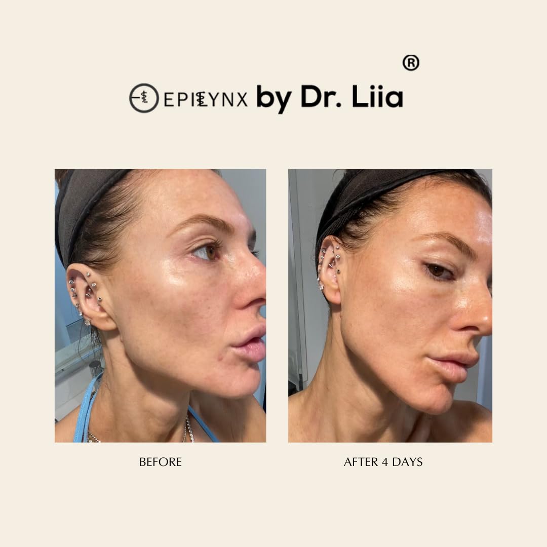 Face Serum for Acne Prone Skin - Moisturizer for Oily Skin - Gluten Free and Vegan for Sensitive Skin with Acne Scars EpiLynx by Dr. Liia - Image 5