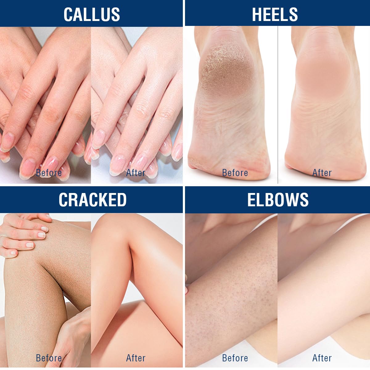 OUKEYA Urea Cream 42% plus Salicylic Acid 2% Net 350g for Dry Cracked Feet, Heels, Knees, Elbows, Hands Repair Treatment.Moisturizes and Removes Corns,Calluses,Dead Skin,and Softens Toenails - Image 9