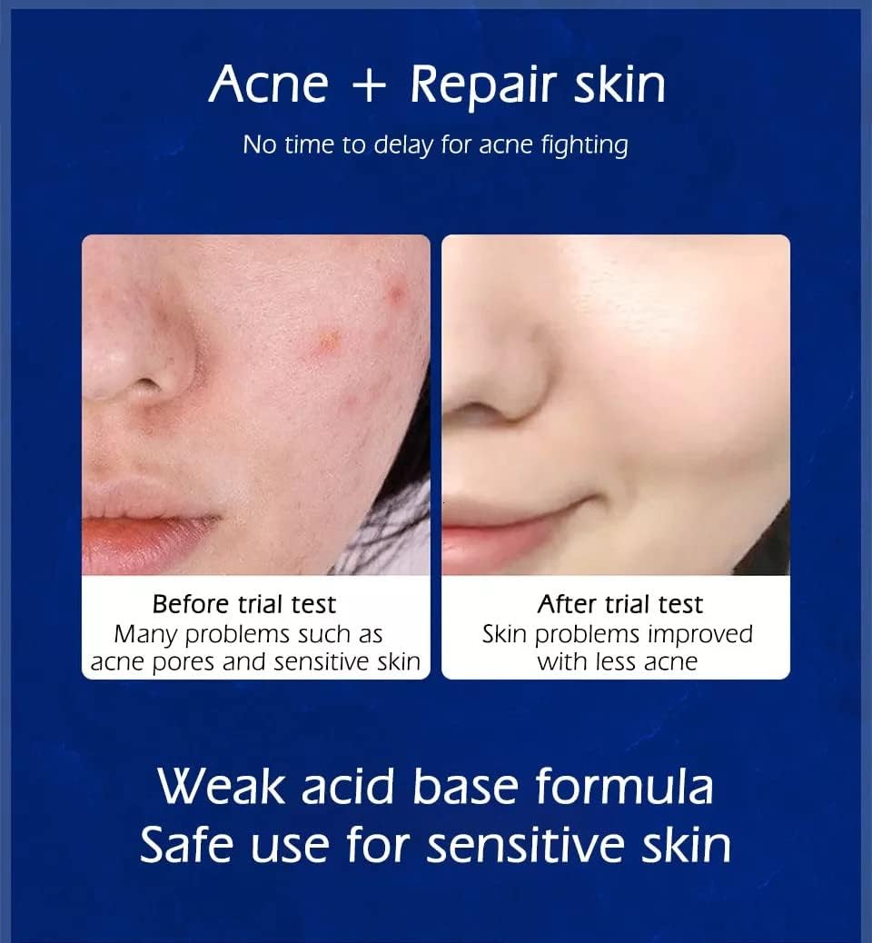 Cystic, Hormonal, Severe Acne Treatment Cream for Teens & Adults with Hyaluronic Acid Aloe Vera Oil Overnight Cystic , Unisex Sensitive Skin Blind Pimple & Blemish Remover (2 PACK)