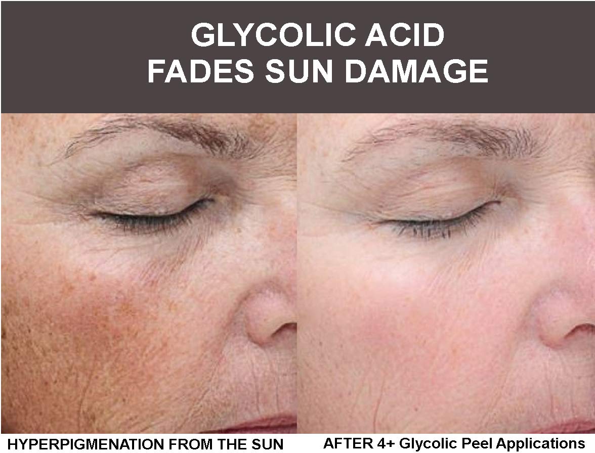 Planet Eden 80% GlyLactic Skin Chemical Peel - Glycolic & Lactic Acid Powerhouse Duo with Anti Aging Antioxidant Recovery Cream & Fan Brush - Intense Anti Aging Treatment - Image 2