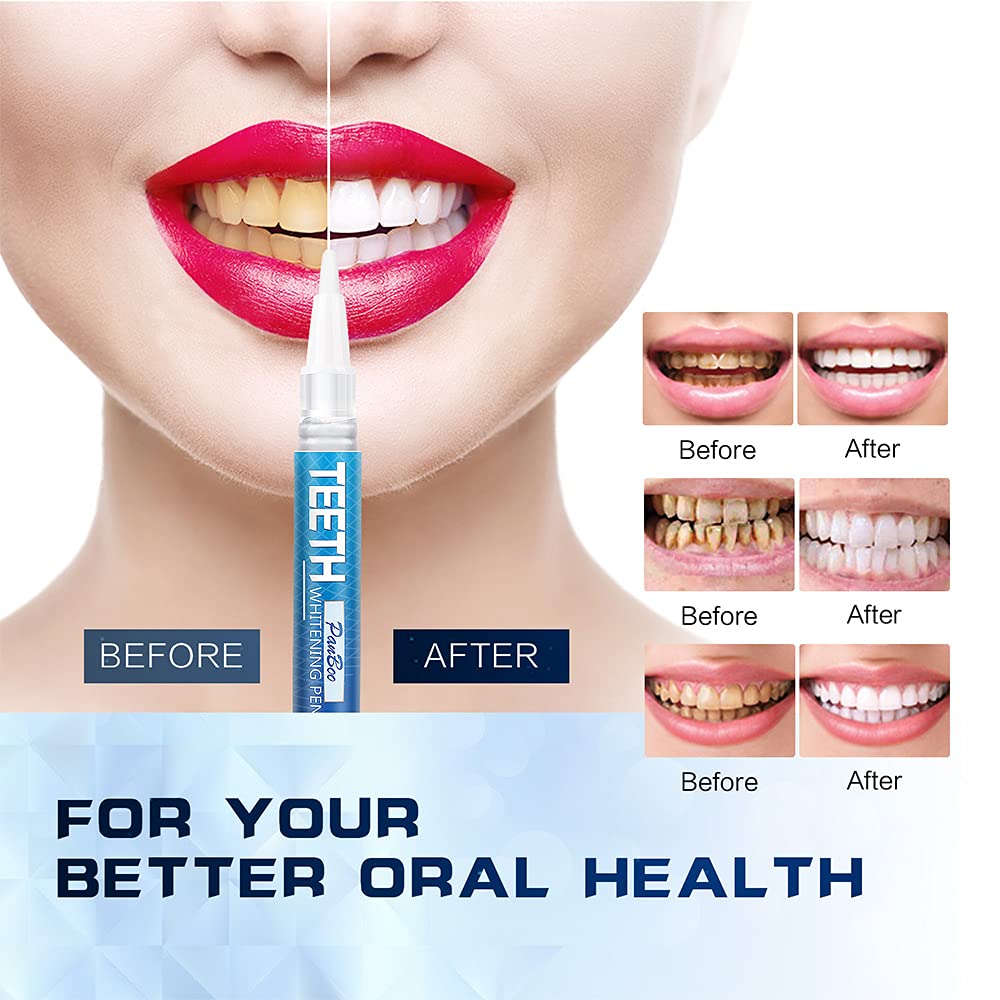 Teeth Whitening Pen, Use Twice a Day Up to 1-6 Shade Whiter in 1-2 Weeks, 4 No Sensitivity Pens, 70+ Whitening Treatments, Effective, Pain Free and Enamel Safe, Easy to Use at Home Travel, Flavourless - Image 2