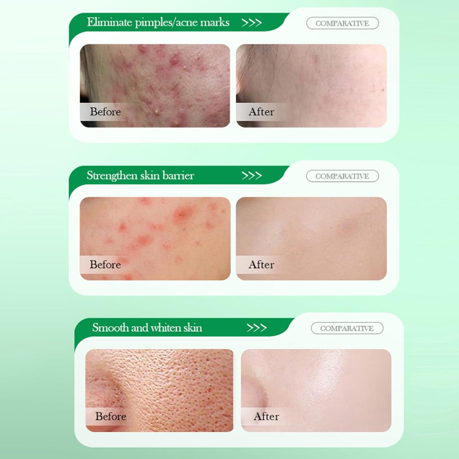 Salicylic Acid Repair Cream,Salicylic Acid Face Moisturizer,Pore Shrinkage Acne Skin Improves Acine Scars Motsturizing,Suitable for Oily, Acne Prone Skin 50g - Image 7